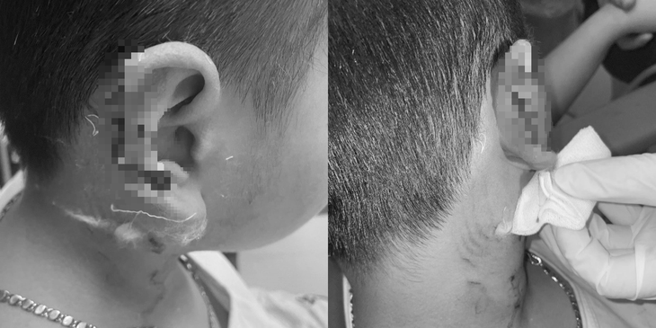 Bé trai bị chó Phú Quốc cào gây biến dạng vành tai - Ảnh: Bệnh viện cung cấp Bé trai bị chó Phú Quốc cào gây biến dạng vành tai - Ảnh: Bệnh viện cung cấp