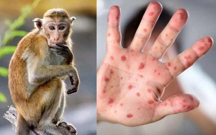 Ca nghi mắc đậu mùa khỉ ở Đà Nẵng là tay chân miệng - Ảnh 1. Dù không phải ca đậu mùa khỉ nhưng tình huống vừa qua cũng đặt ngành y tế Đà Nẵng trong tình hình báo động - Ảnh minh họa: Bộ Y tế