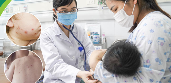 Bệnh thủy đậu vào mùa, cha mẹ đừng chủ quan - Ảnh 1. Bệnh thủy đậu vào mùa, cha mẹ đừng chủ quan - Ảnh 1.