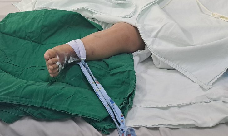 Bị rắn hổ mèo cắn, bé trai bị nhiễm độc toàn thân - Ảnh 1. Vết thương ở chân của bé trai 22 tháng tuổi bị rắn hổ mèo cắn - Ảnh: Bệnh viện cung cấp